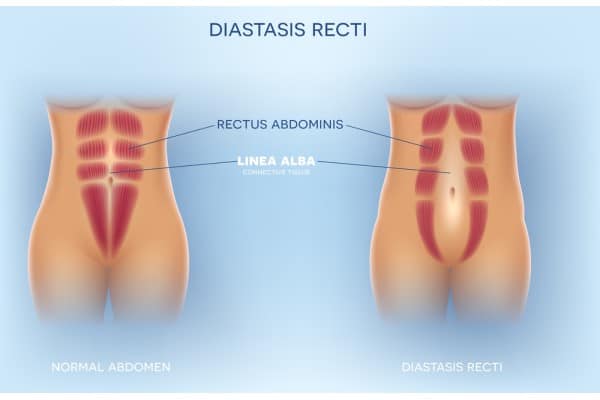What Non-Surgical Options Are Available for Diastasis Recti Hackney?