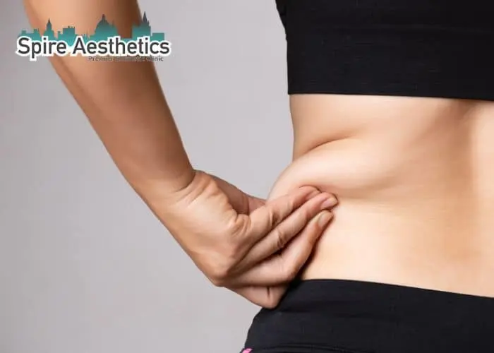 Image of woman pinching fat on their hips Hackney. Fat Freezing treatment