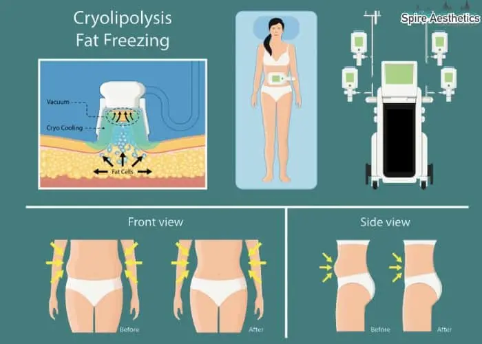 Fat freezing treatment Hackney benefits for competitions to remove stubborn fat deposits.