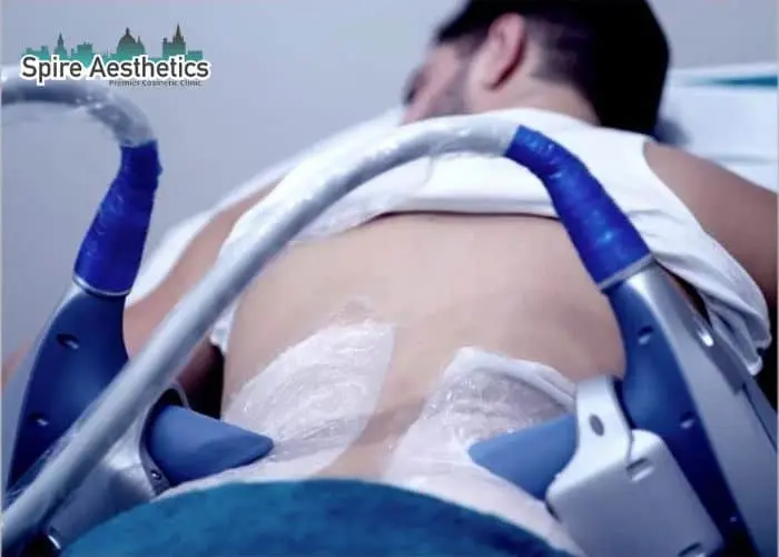 Man having fat freezing treatment done on love handles before a competitions Hackney to create a sculpted look.