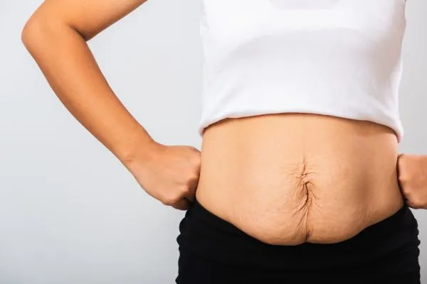 Image of a woman's stomach after weight loss with sagging skin following a gastric band Hackney