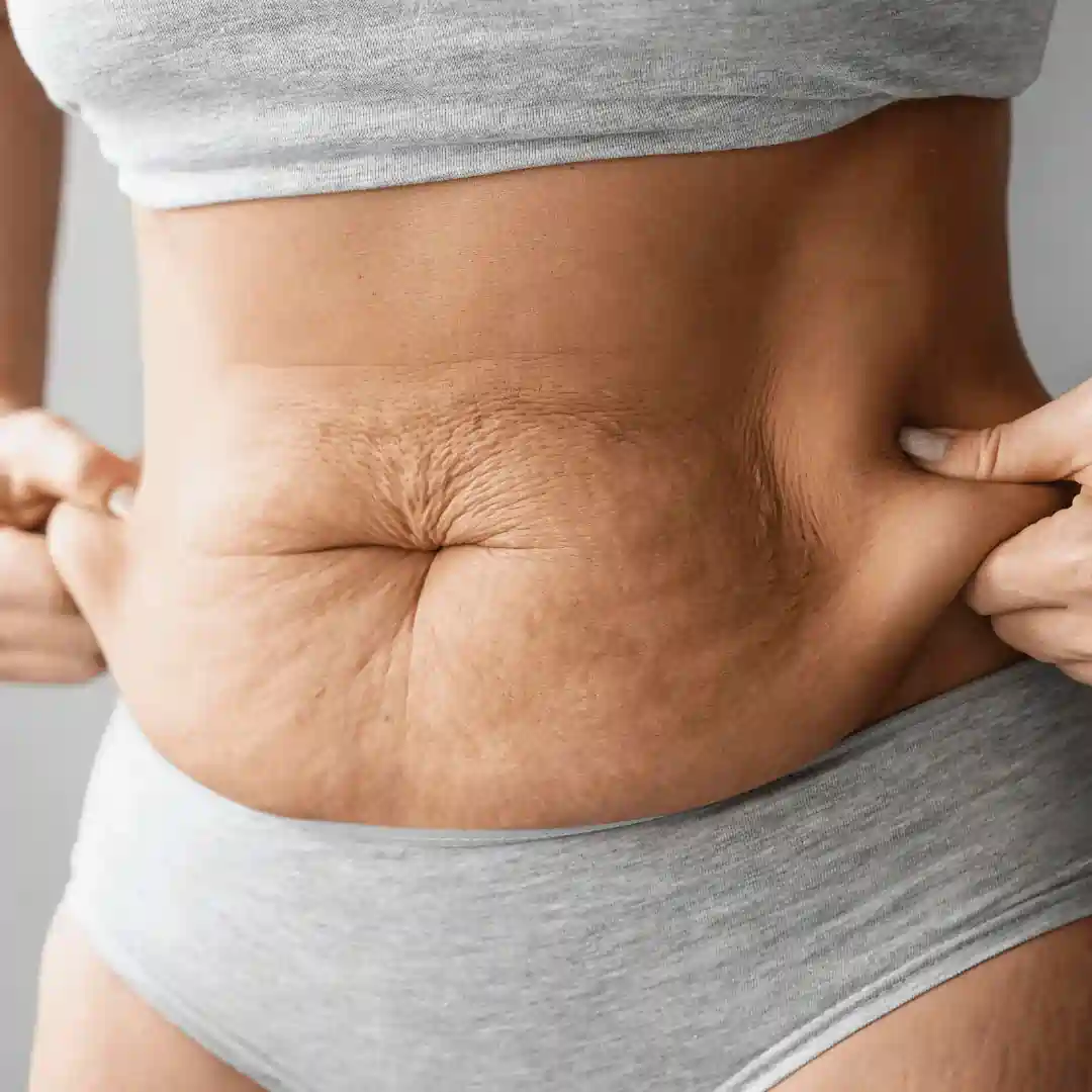 Is It Normal to Have Loose Skin After Pregnancy Hackney?