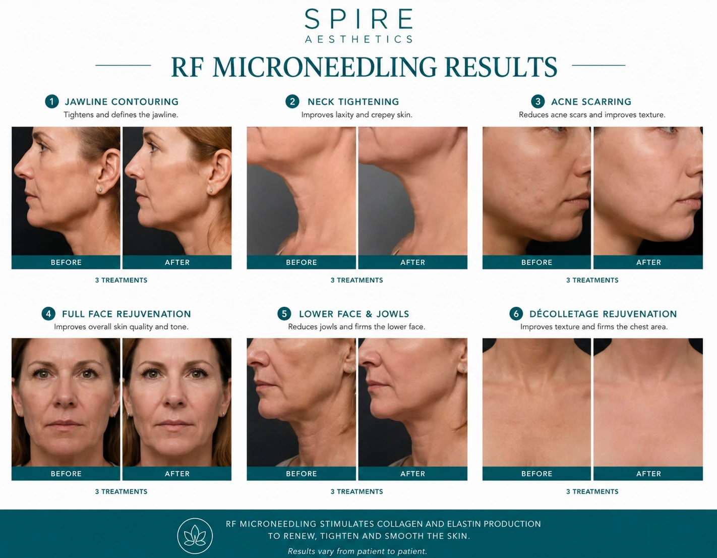 RF Microneedling Skin tightening Hackney results