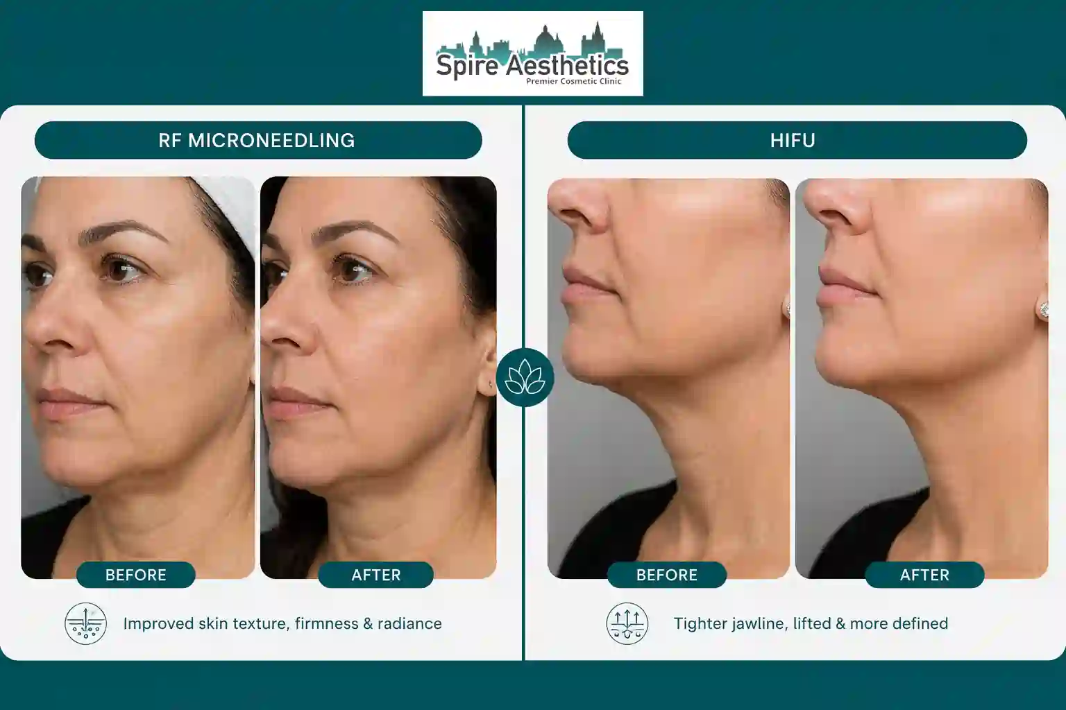 Can RF Microneedling and HIFU Be Combined Hackney?