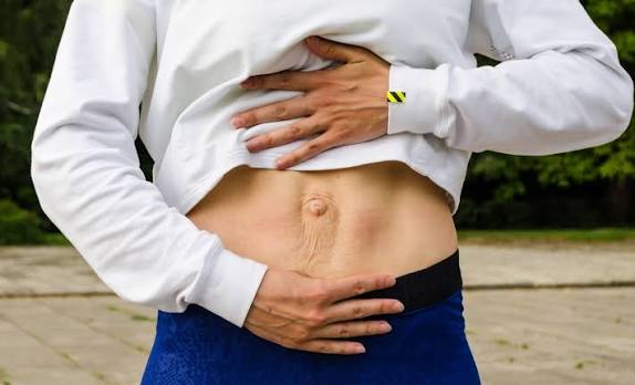 When Could Diastasis Recti Be the Missing Piece of the Puzzle Hackney?