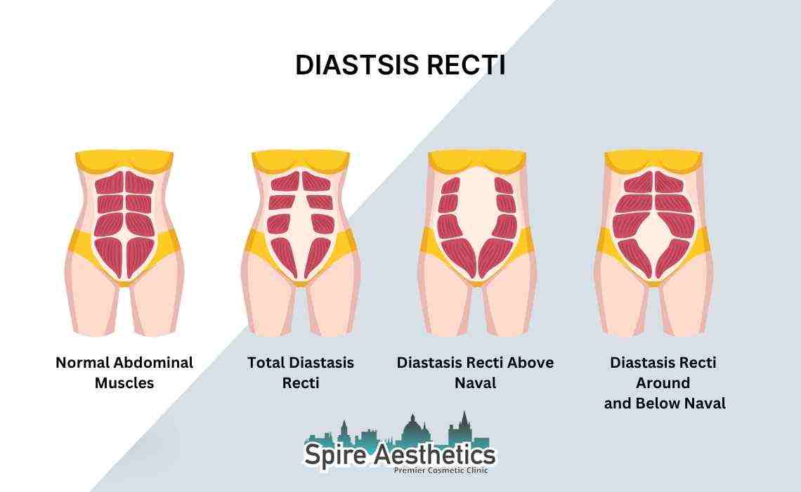 Is Non-Surgical Diastasis Recti Treatment Right for You? Common Concerns Answered Hackney